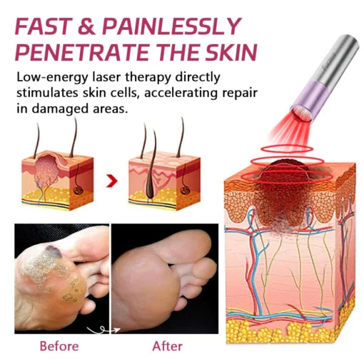 Furzero™ laser handheld therapy device for nail fungus treatment