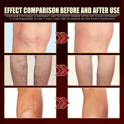 2 PCS Sumifun®Varicose Vein Cream✅ 7-Day Improvement Guarantee – Full Refund if No Results
