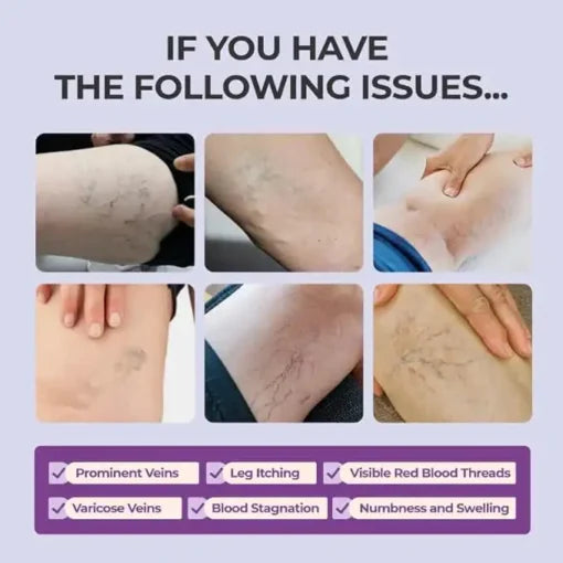 AQA™ cream for relieving varicose veins on the legs