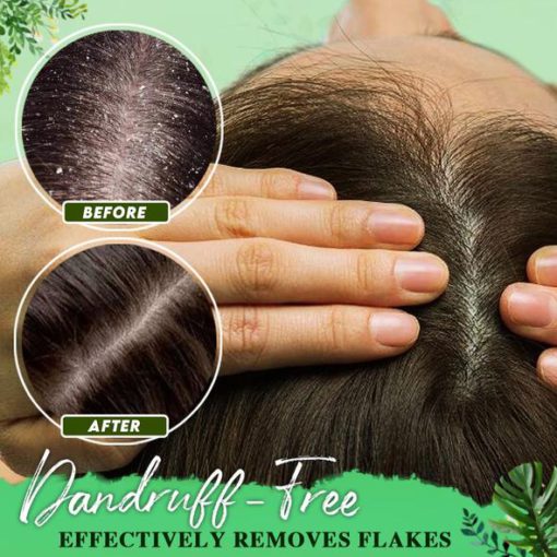 Essence for treating dandruff