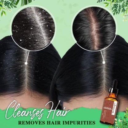 Essence for treating dandruff