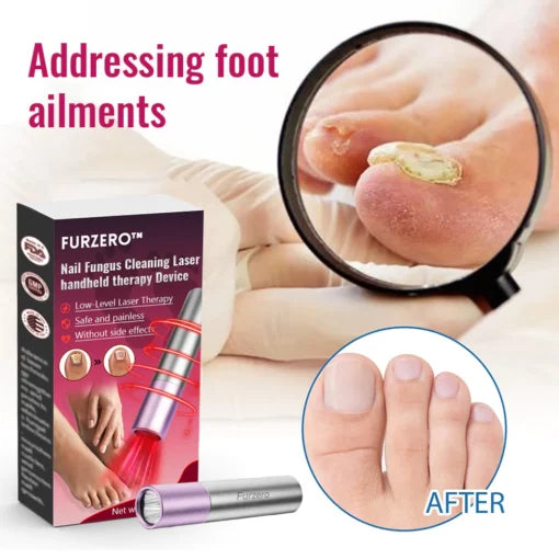 Furzero™ laser handheld therapy device for nail fungus treatment