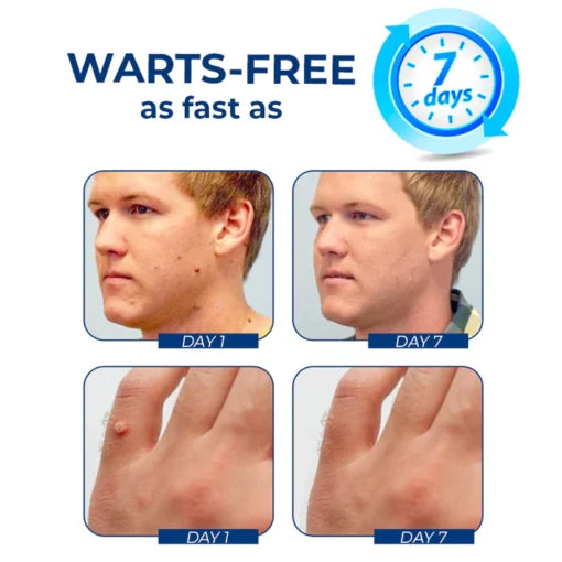 GFOUK™ WartsClean Wart Eradication Cream