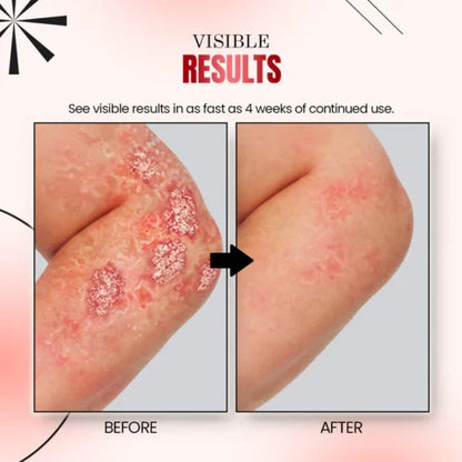 Ourlyard™ Psoriasis Relief Spray