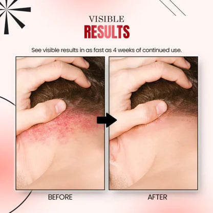 Ourlyard™ Psoriasis Relief Spray