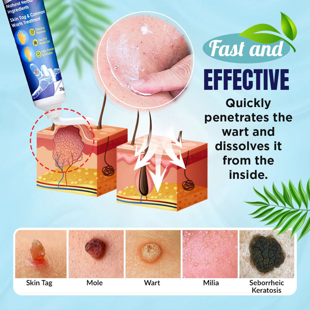 Herbal Wart Treatment Cream【3 Day Delivery&Cash on delivery】